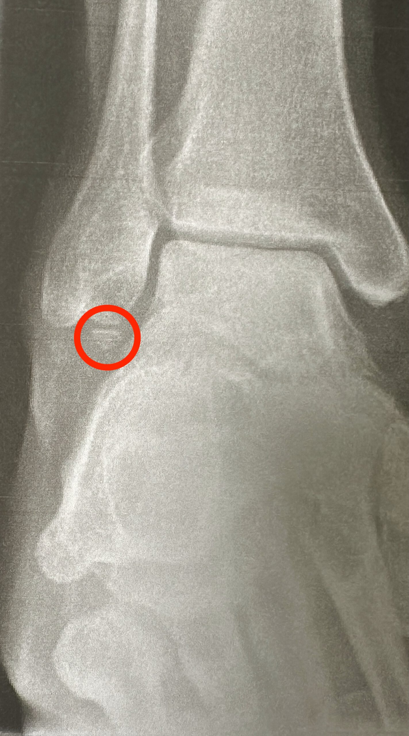 Röntgenbild eines rechten Sprunggelenks. Ein roter Kreis markiert ein Knochenfragment, das sich vom Gelenk gelöst hat.